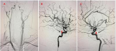 Case Report: Stent Retriever Thrombectomy of Acute Basilar Artery Occlusion via the Type 1 Proatlantal Intersegmental Artery